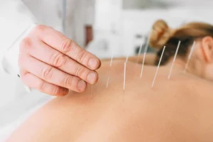 dry needling Melbourne dry needling Melbourne